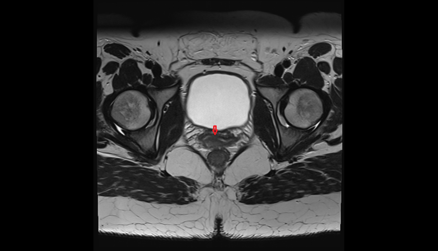 Anterior fornix of cervix  MRI axial image-img-00000-00000