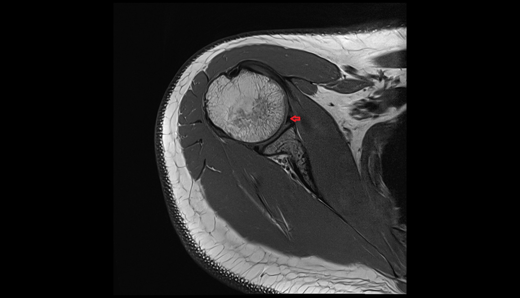 Anterior glenoid labrum