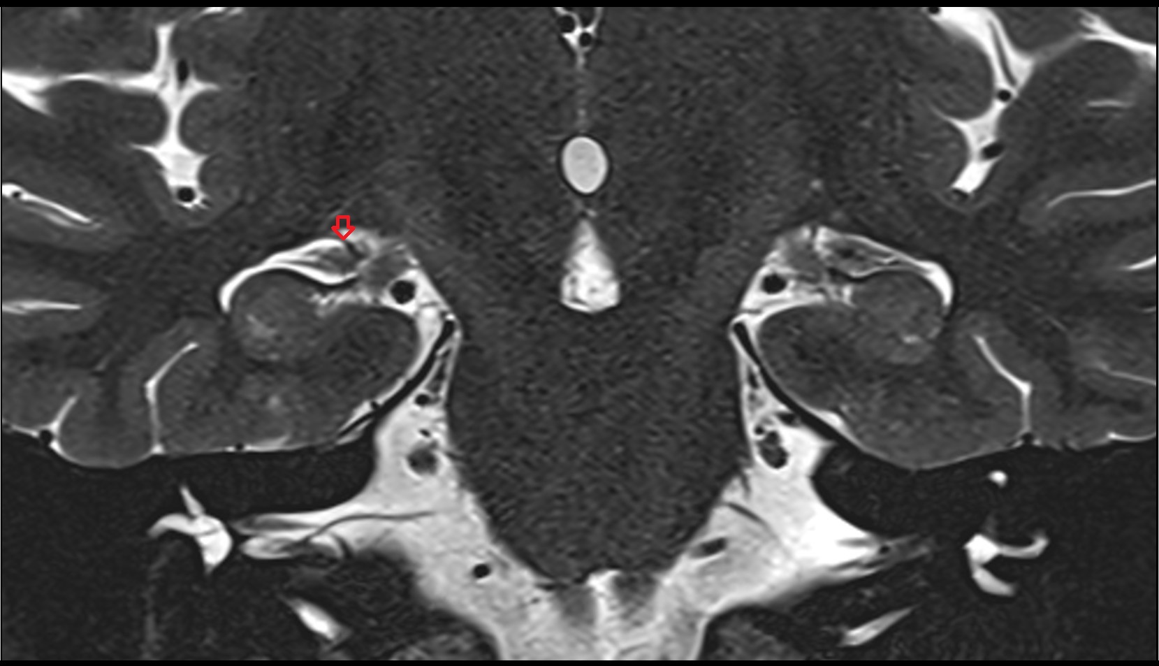 Anterior hippocampal veins