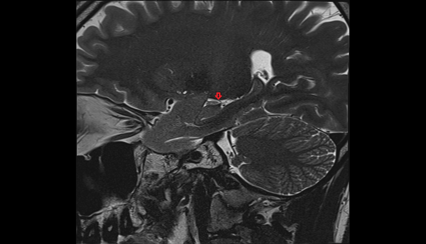 Anterior hippocampal veins  mri SAG  image -img-00000-00000