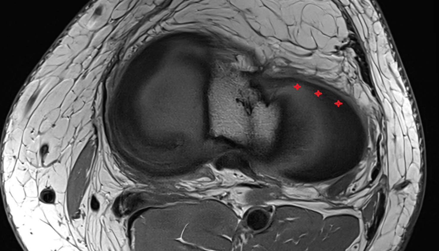 Anterior horn of lateral meniscus  axial  cross sectional anatomy 3T MRI AI enhanced  radiology  anatomy image-img-00000-00000