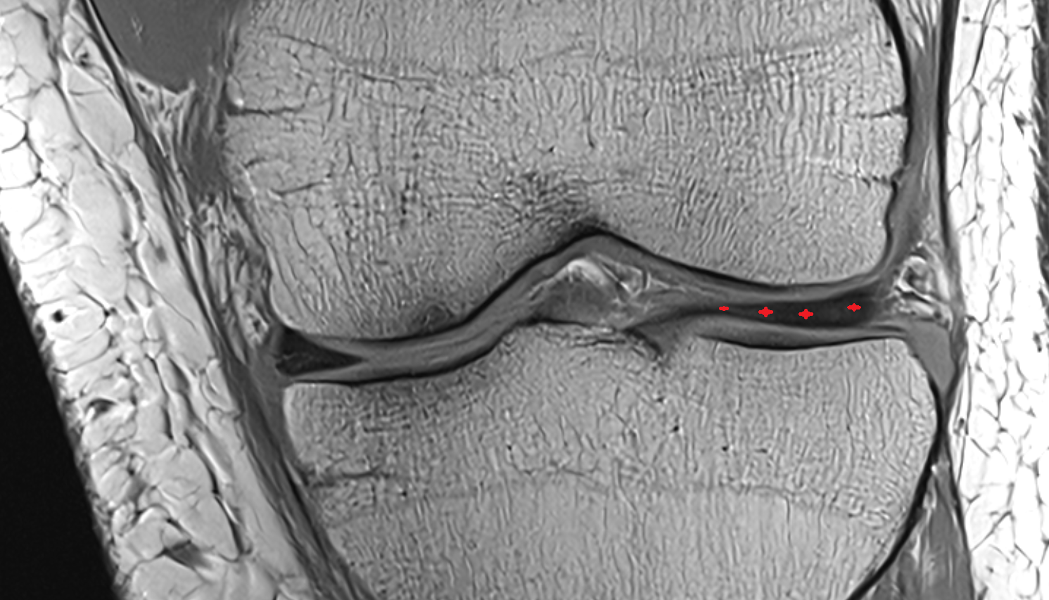 Anterior horn of lateral meniscus  coronal  cross sectional anatomy 3T MRI AI enhanced  radiology  anatomy image-img-00000-00000