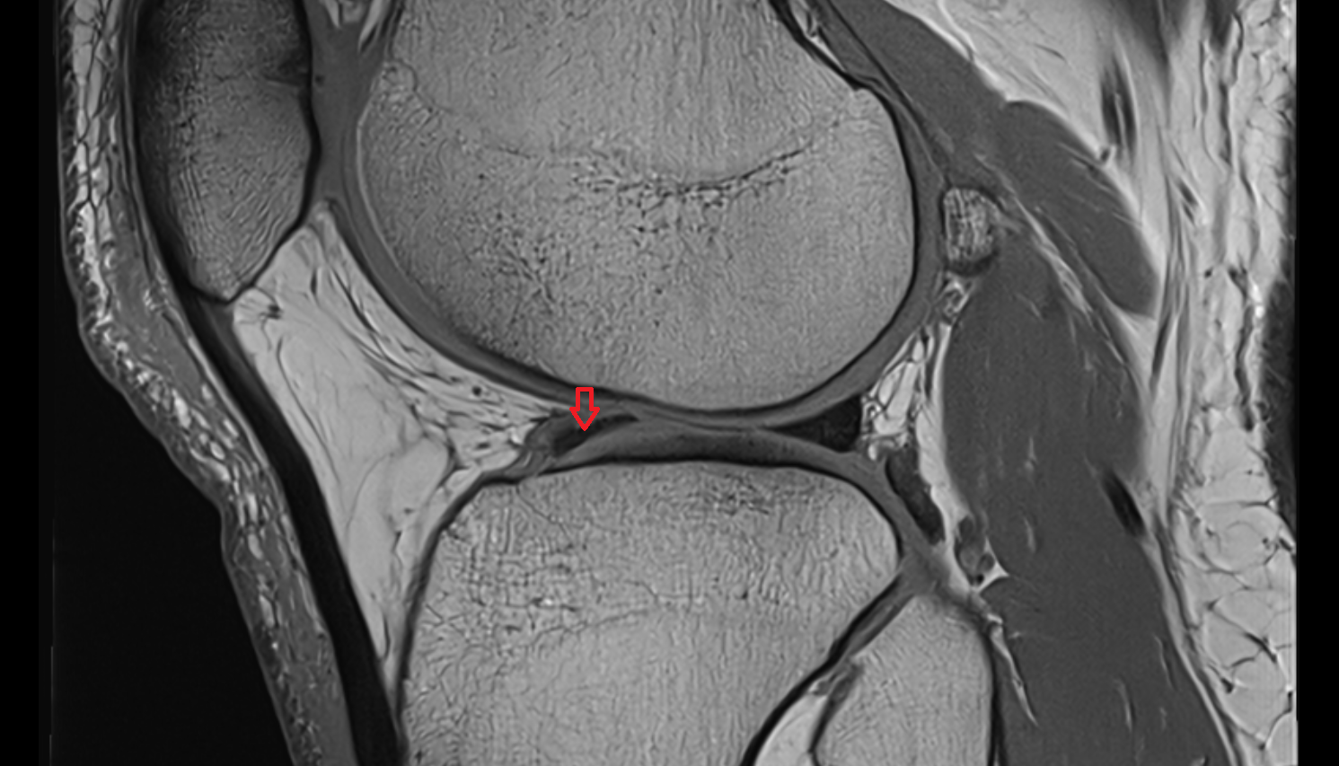 Anterior horn of lateral meniscus  sagittal  cross sectional anatomy 3T MRI AI enhanced  radiology  anatomy image-img-00000-00000