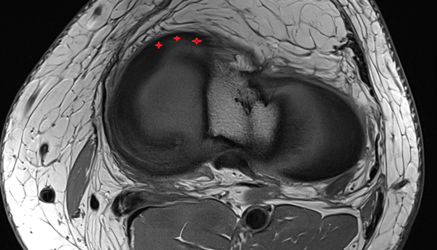 Anterior horn of medial meniscus  axial  cross sectional anatomy 3T MRI AI enhanced  radiology  anatomy image-img-00000-00000