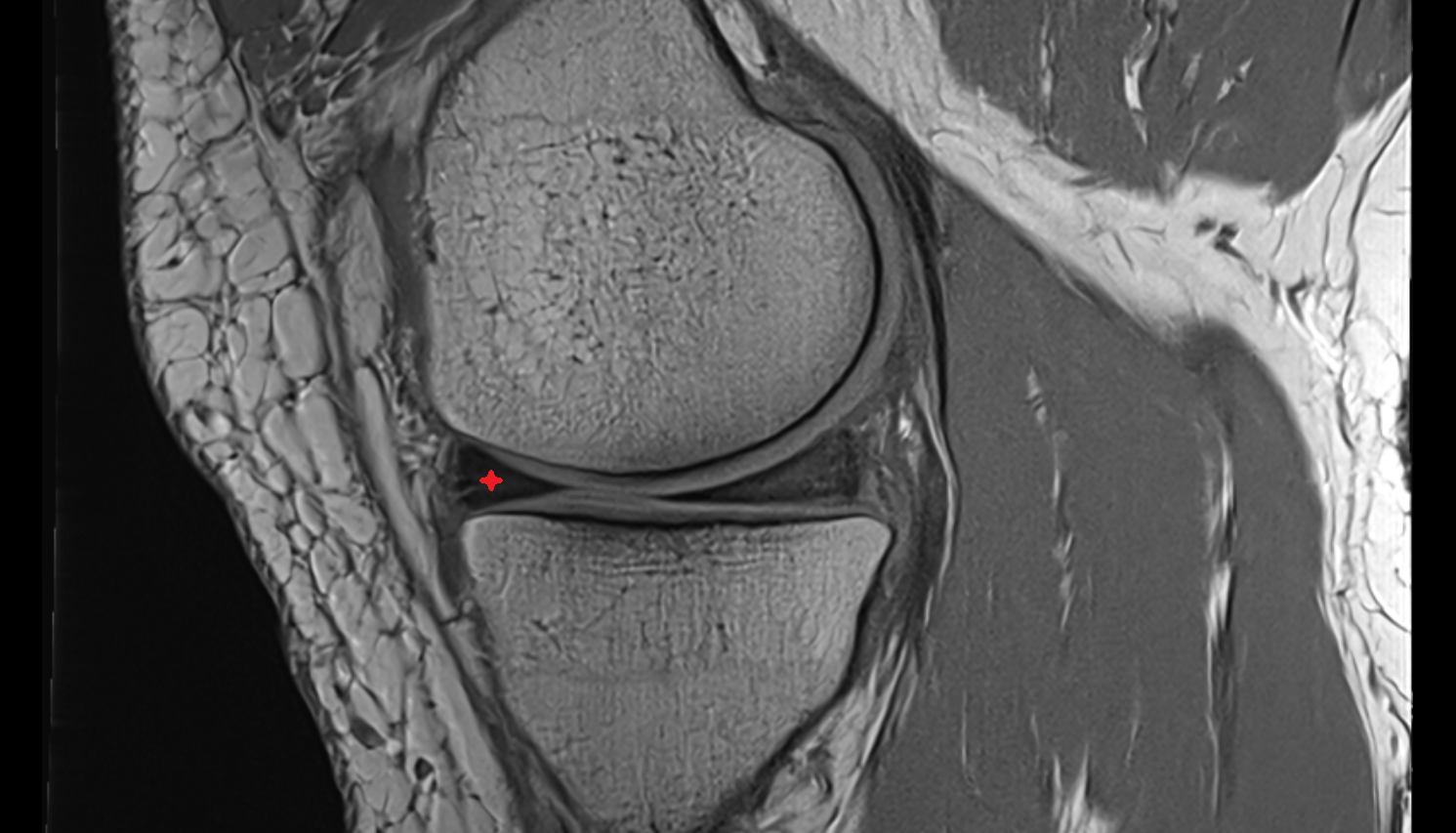 Anterior horn of medial meniscus  sagittal  cross sectional anatomy 3T MRI AI enhanced  radiology  anatomy image-img-00000-00000