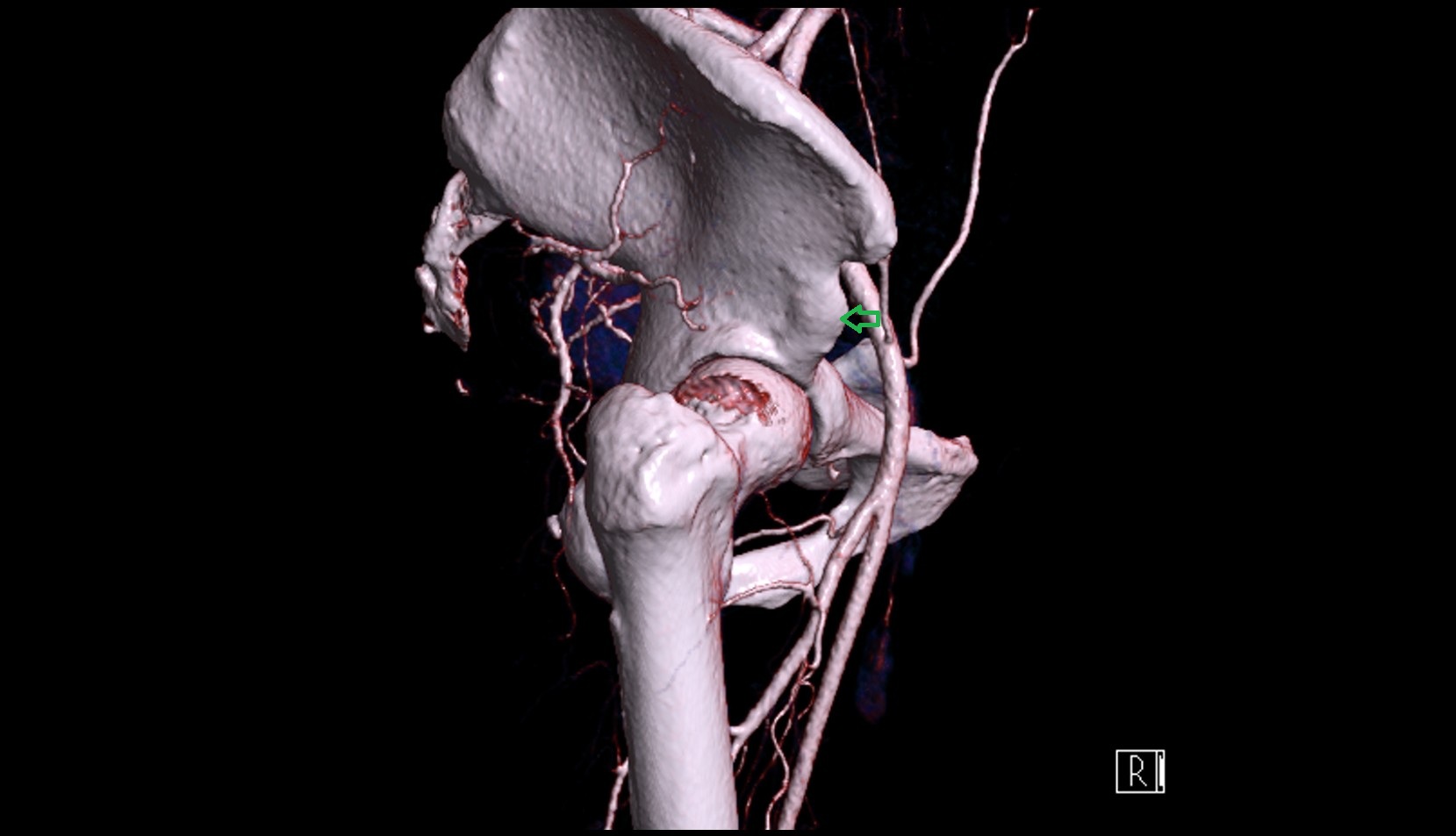 Anterior inferior iliac spine 3d image