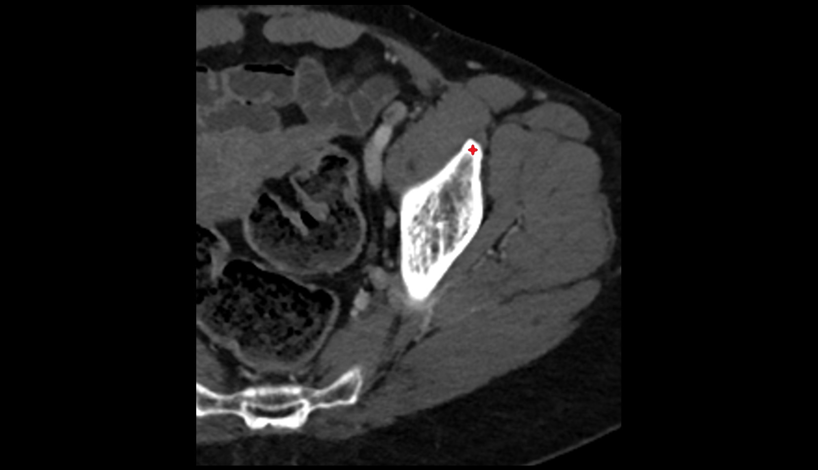 Anterior inferior iliac spine  CT axial image