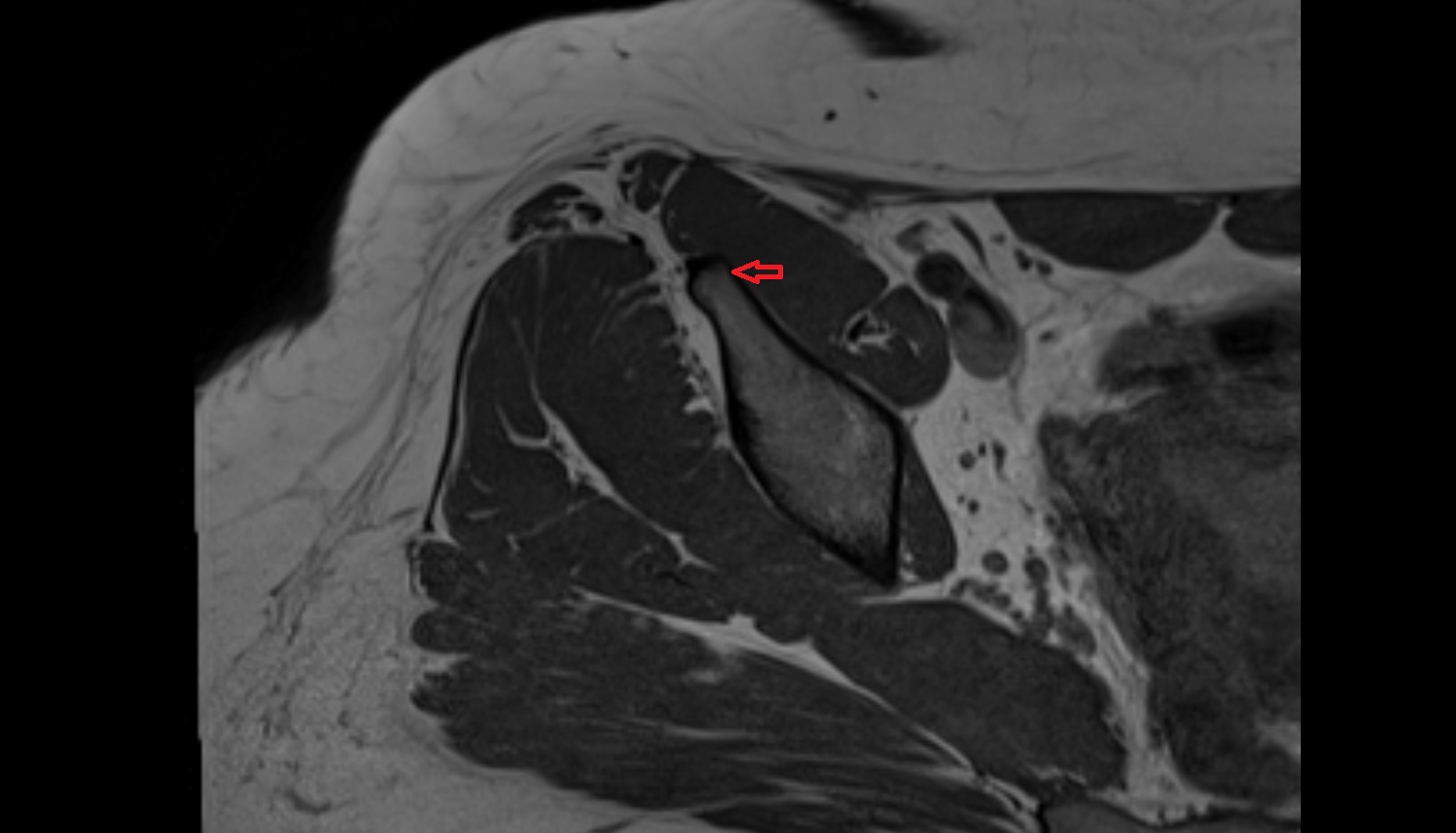Anterior inferior iliac spine MRI  axial  anatomy  image-img-00000-00000