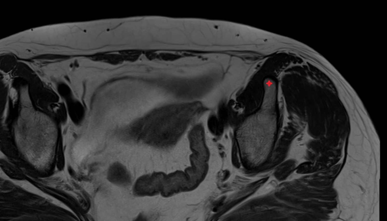 Anterior inferior iliac spine MRI  axial  anatomy  image-img-00000-00000_00002