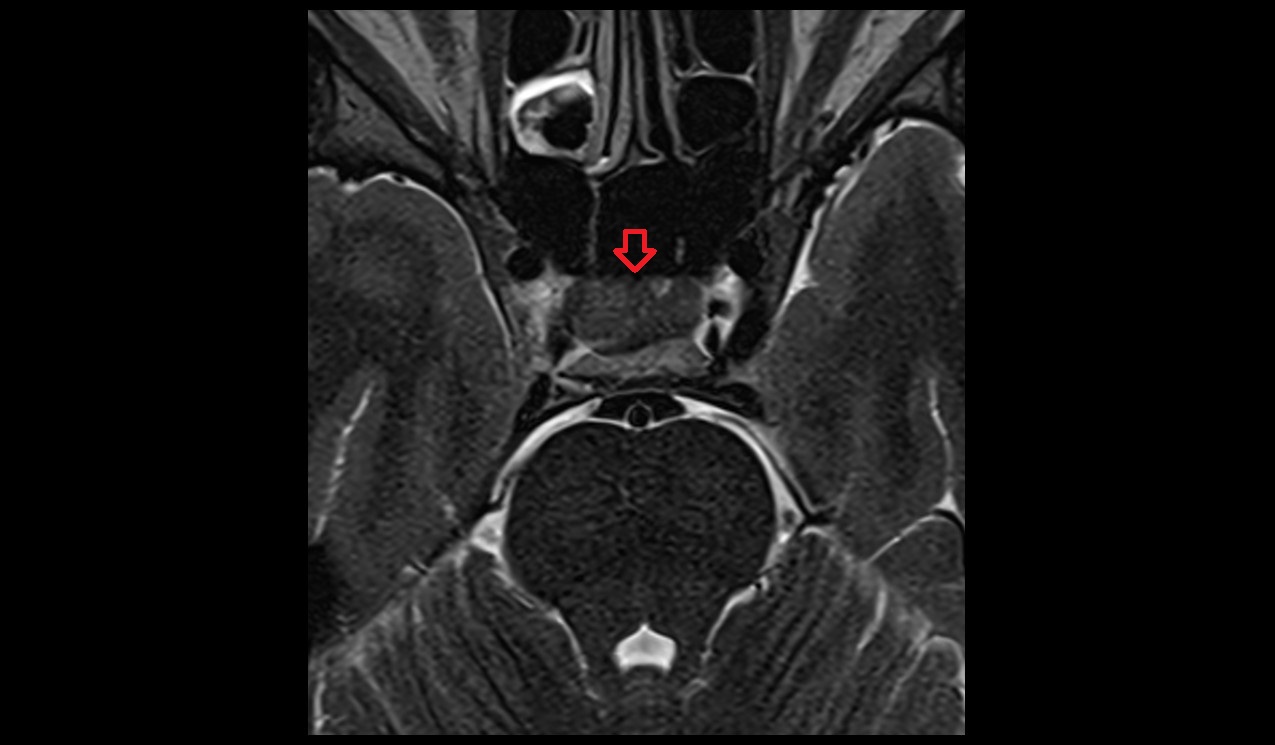 Anterior intercavernous sinus mri 3t axial image