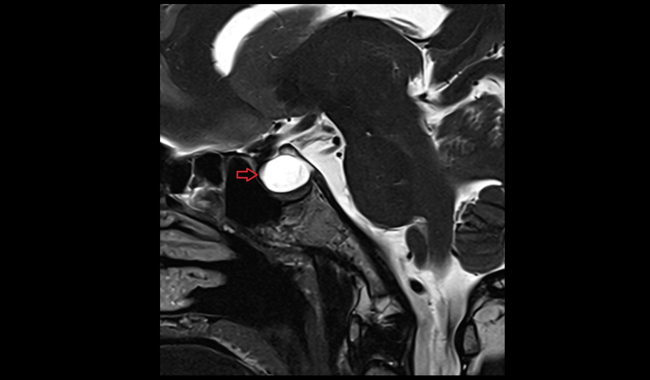 Anterior intercavernous sinus mri 3t sagittal image