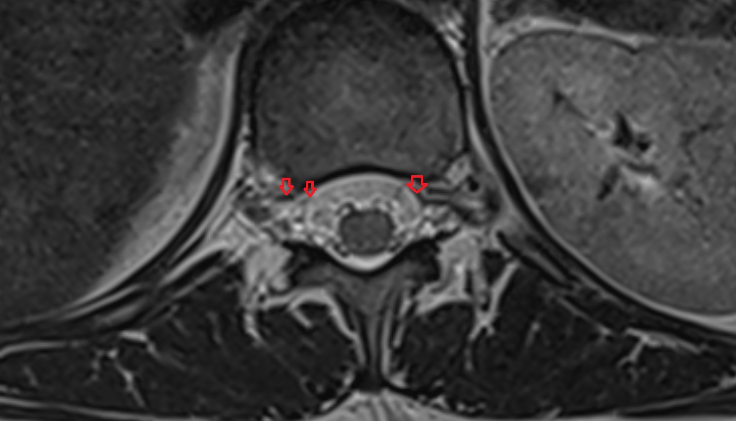 Anterior internal vertebral venous plexus mri axial  image -img-00000-00000