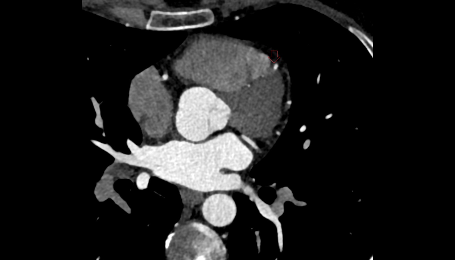 Anterior interventricular sulcus  CT  axial image -img-00000-00000