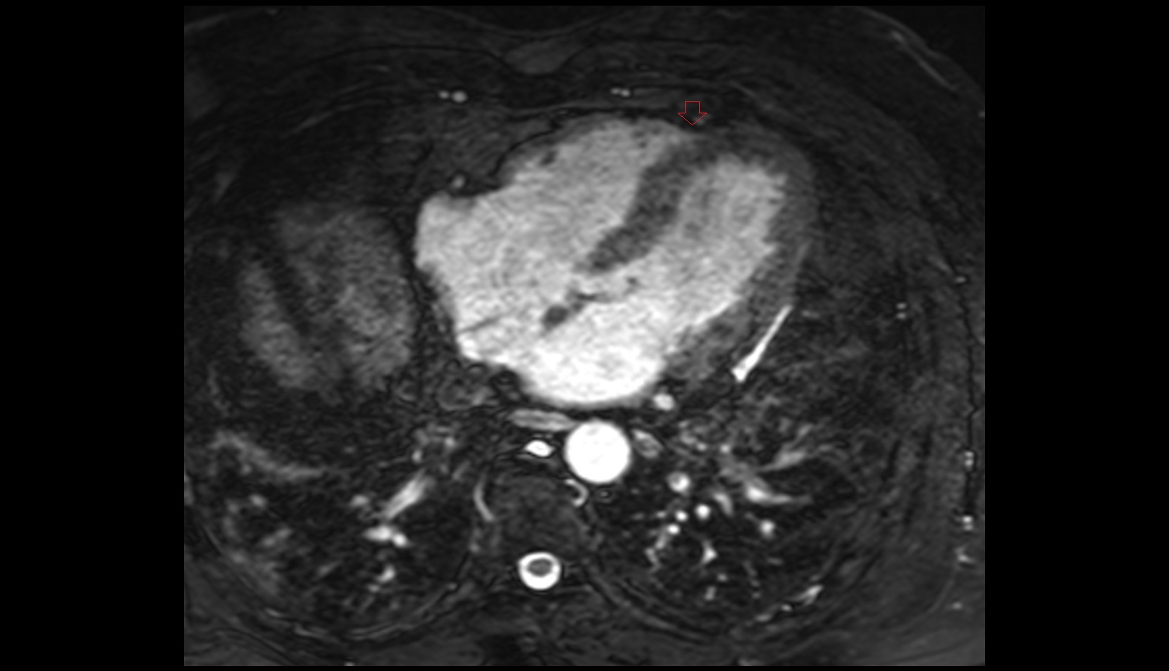 Anterior interventricular sulcus mri axial image