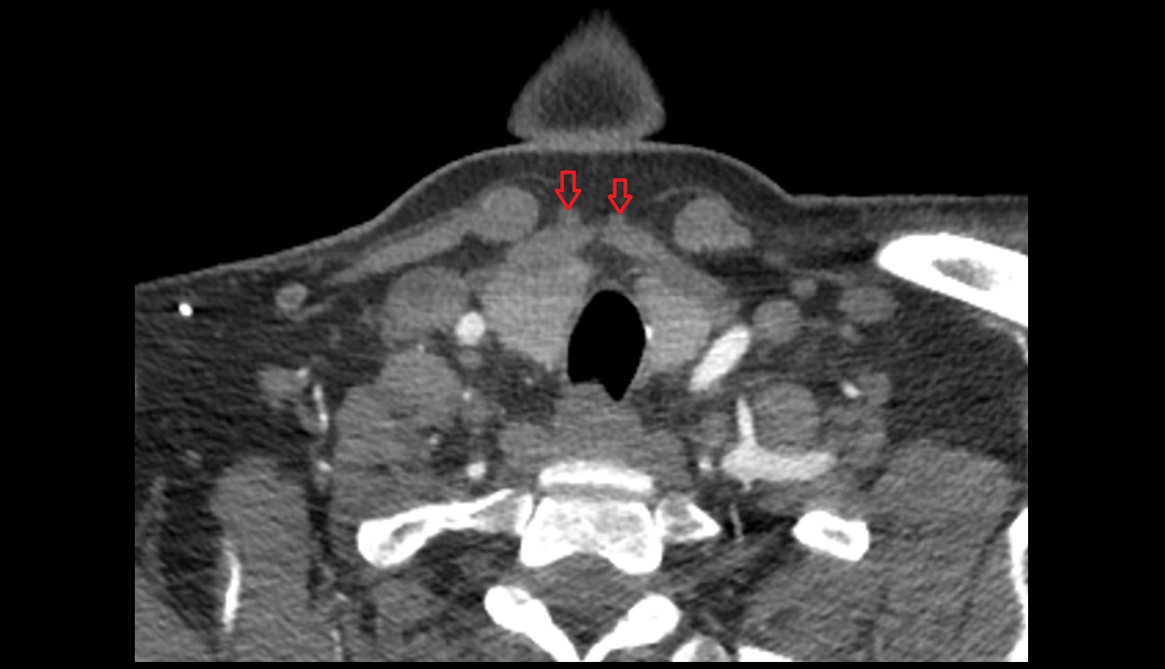 Anterior jugular vein CT IMAGE
