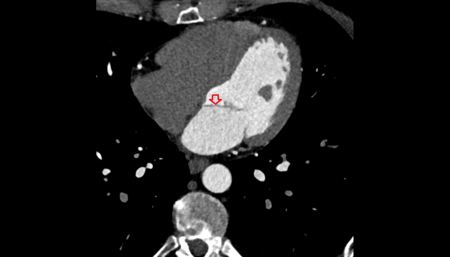 Anterior leaflet of left atrioventricular valve MRI coronal image -img-00000-00000