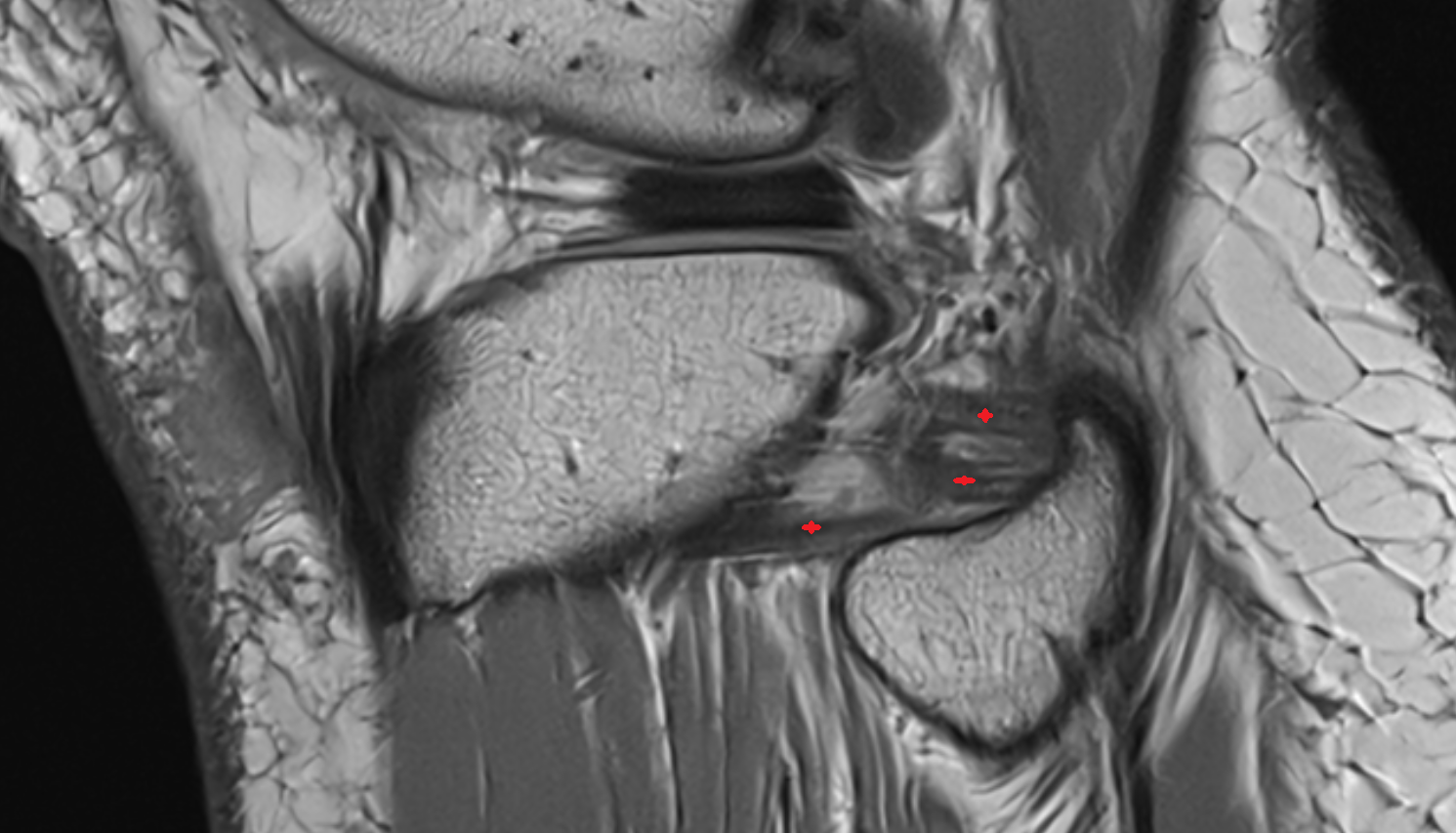 Anterior ligament of fibular head SAGITTAL  cross sectional anatomy 3T MRI AI enhanced  radiology  anatomy image-img-00000-00000