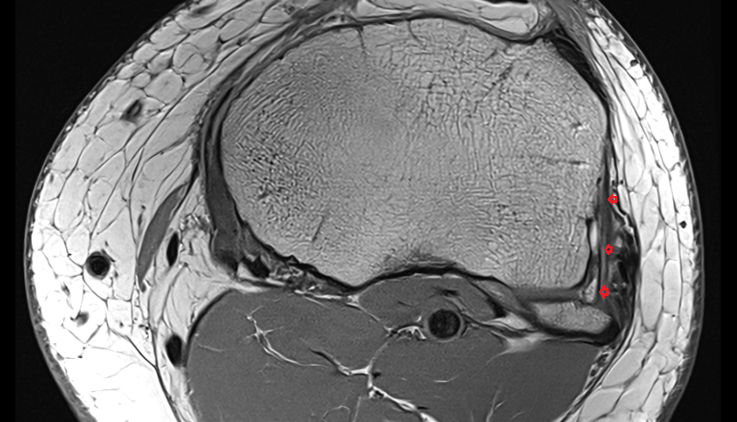 Anterior ligament of fibular head axial  cross sectional anatomy 3T MRI AI enhanced  radiology  anatomy image-img-00000-00000