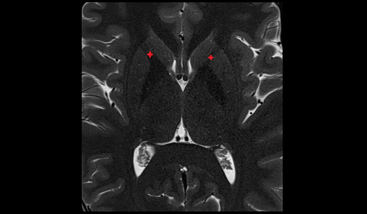 Anterior limb of internal capsule mri 3t axial image