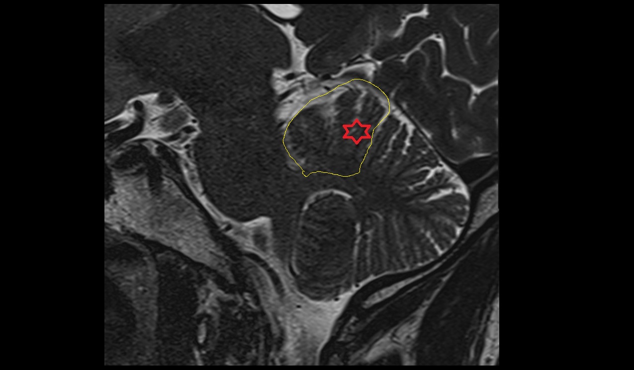 Anterior lobe of cerebellum MRI 3T image