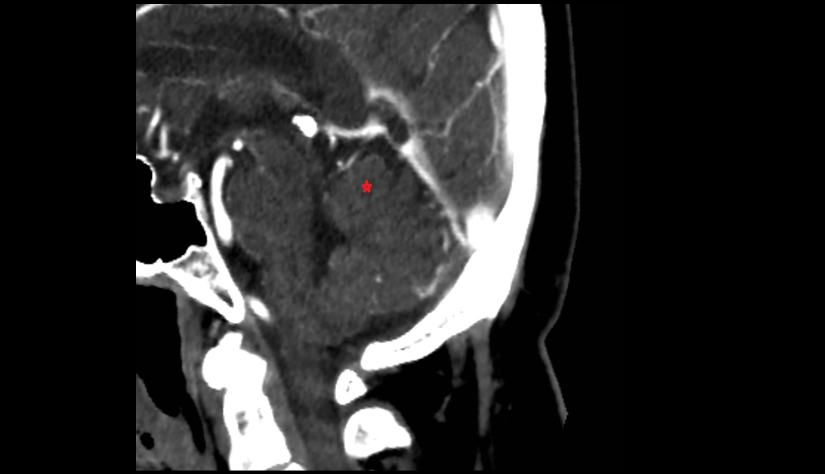 Anterior lobe of cerebellum  ct  image