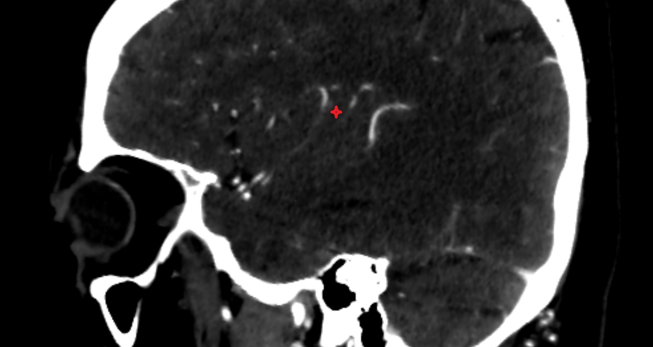 Anterior long insular gyrus  CT  sag anatomy image -img-00001-00001