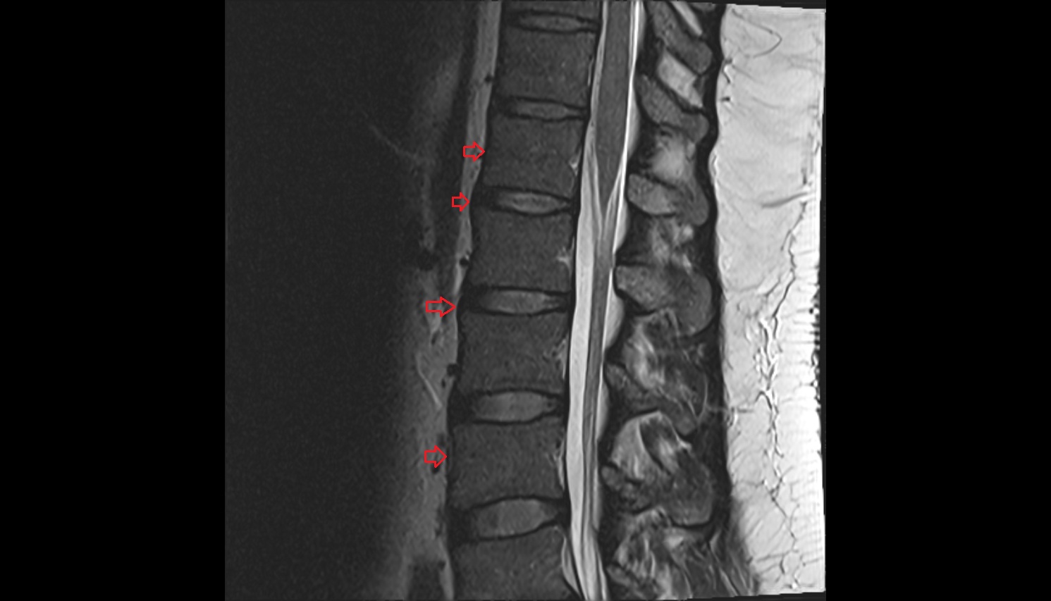 Anterior longitudinal ligament   MRI sagittal  anatomy  image -img-00000-00000