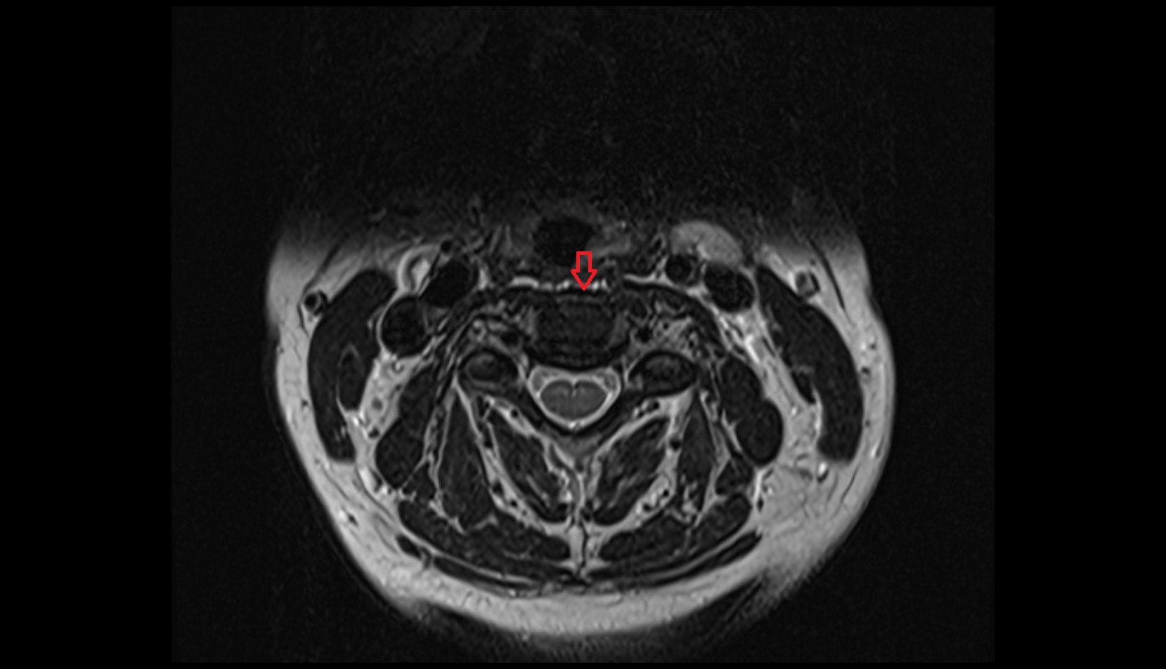 Anterior longitudinal ligament c spine