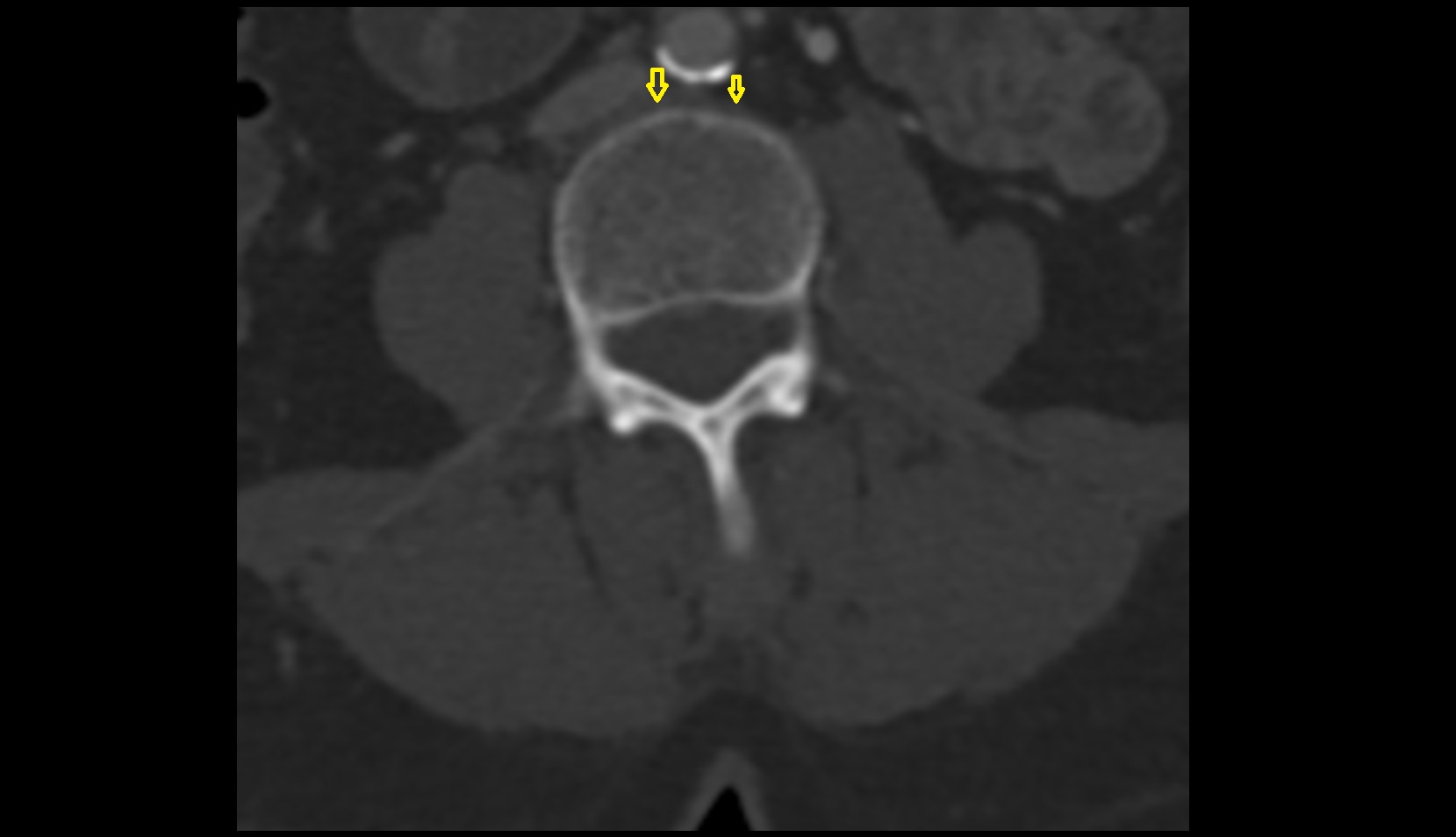 Anterior longitudinal ligament ct axial image