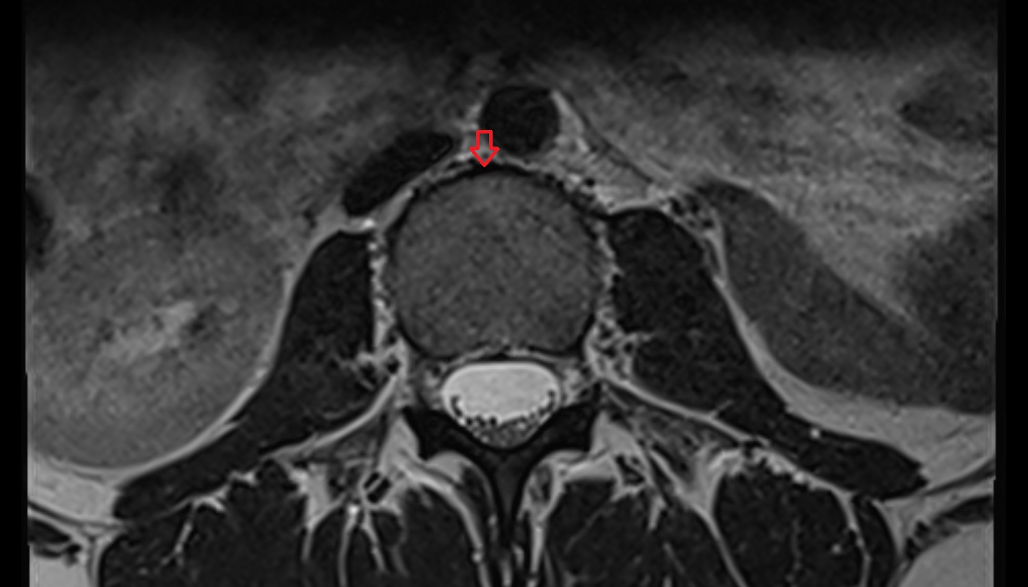 Anterior longitudinal ligament  mri axial  image -img-00000-00000