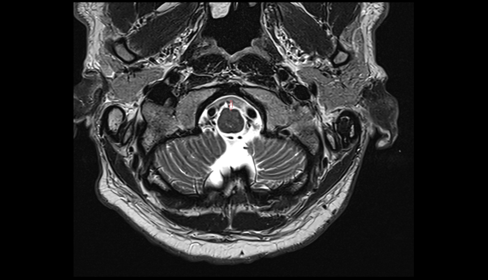 Anterior median fissure of medulla oblongata MRI 3T axial image