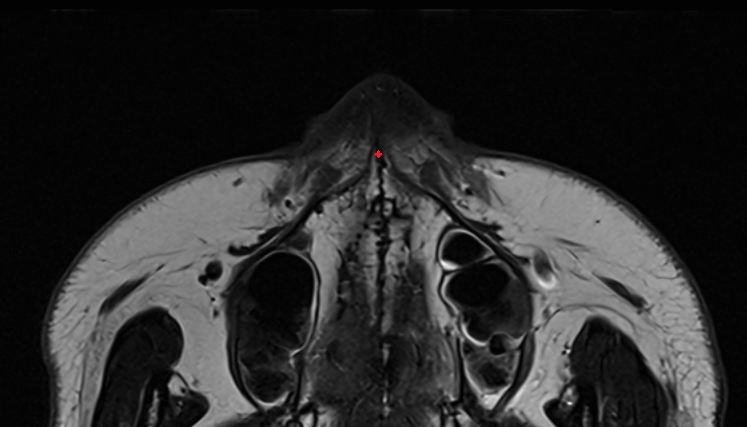 Anterior nasal spine  mri axial image -img-00000-00000