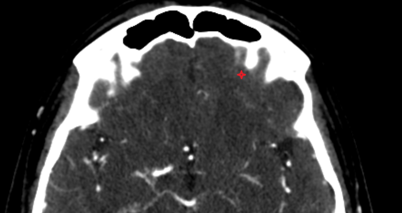 Anterior orbital gyrus  CT axial anatomy image -img-00001-00001
