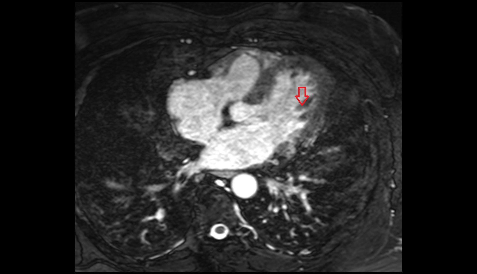 Anterior papillary muscle of left ventricle mri axial image
