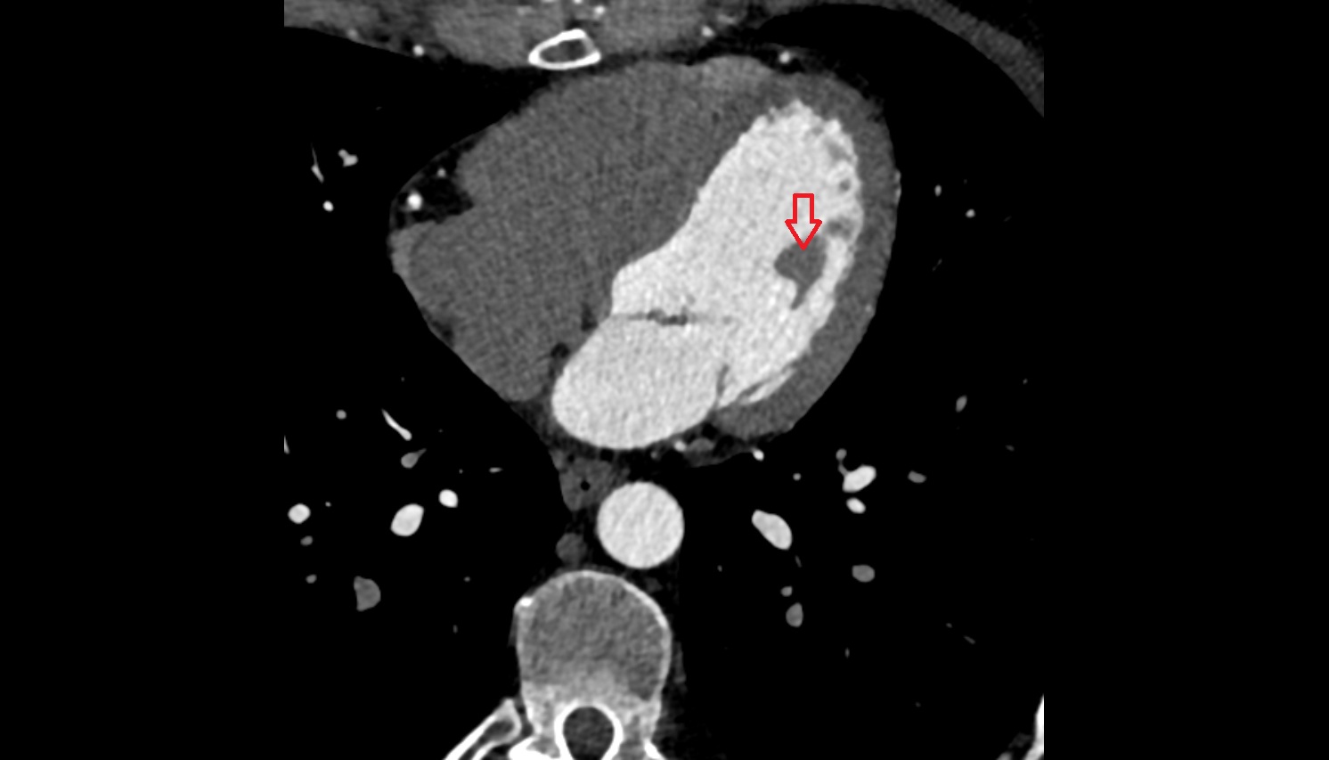 Anterior papillary muscle of ventricle anatomy CT axial image -img-00000-00000