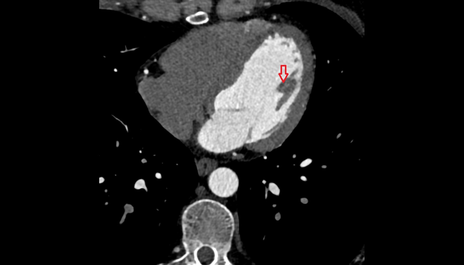 Anterior papillary muscle of ventricle anatomy CT axial image -img-00000-00000_00001