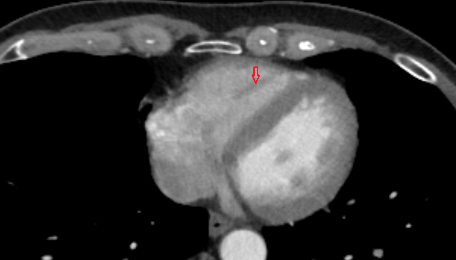 Anterior papillary muscle of ventricle anatomy CT axial image -img-00000-00000_00002