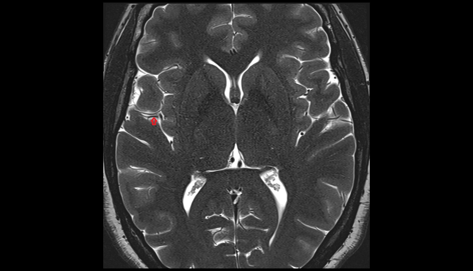 Anterior parietal artery