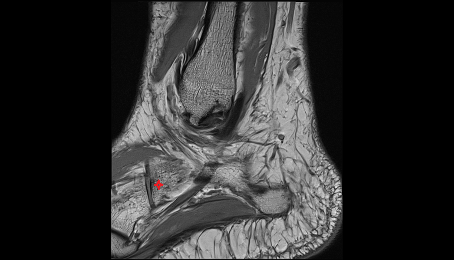 Anterior process of calcaneus MRI cross sectional anatomy 3T MRI AI enhanced radiology image-img-00000-00000