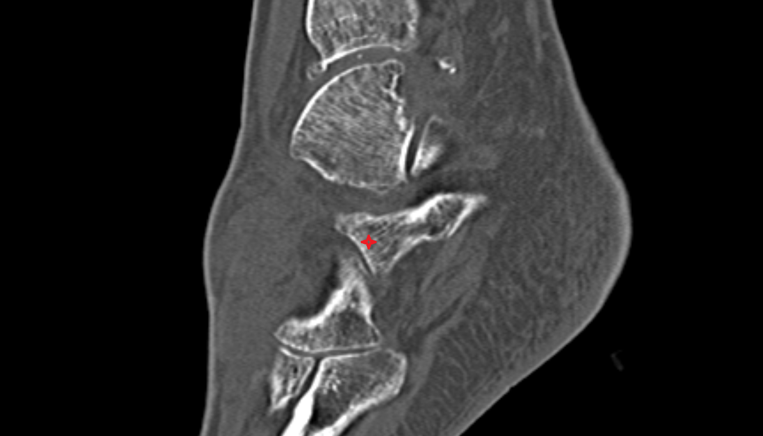 Anterior process of calcaneus ct cross sectional anatomy  AI enhanced radiology image-img-00000-00000