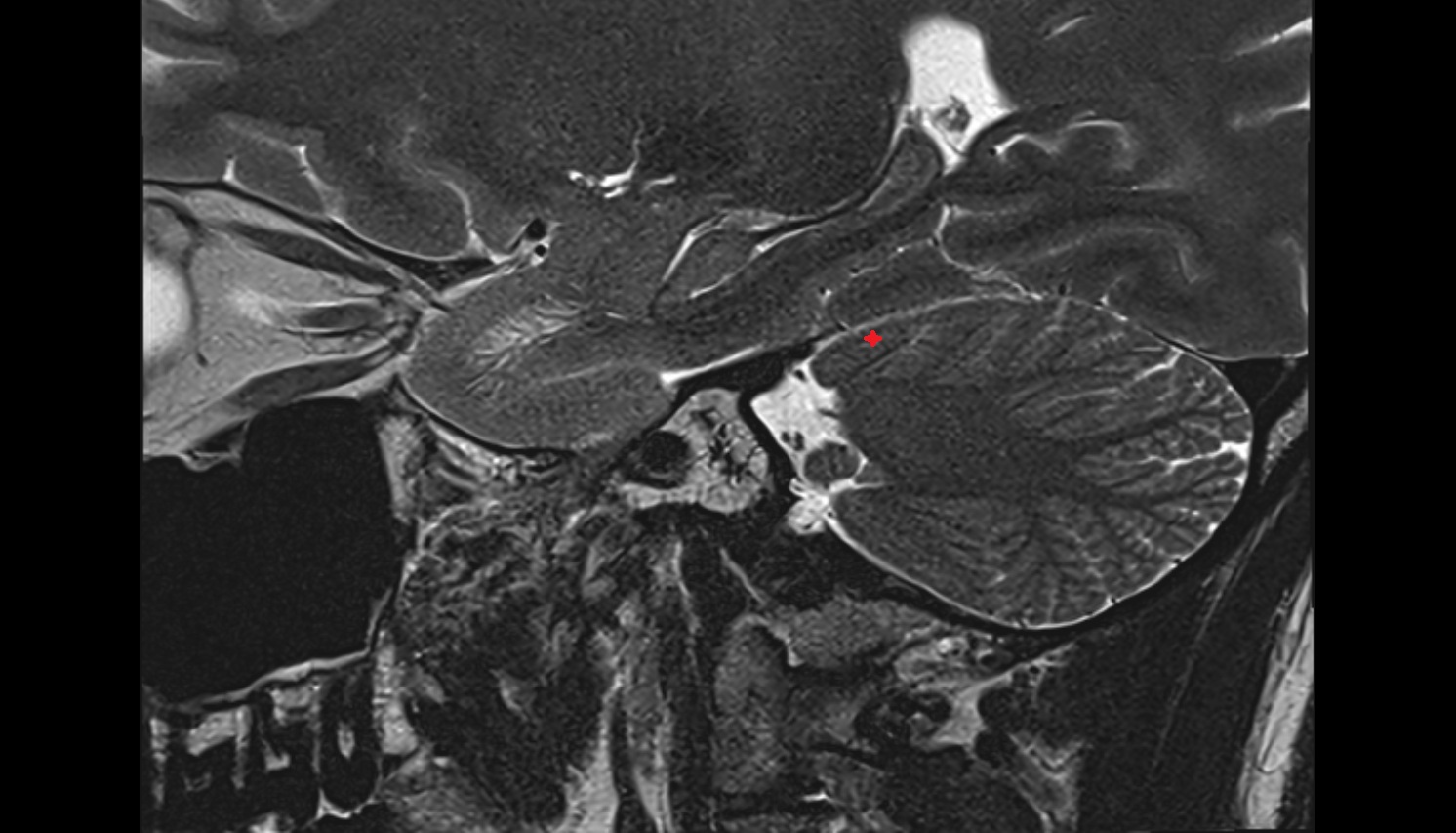 Anterior quadrangular lobule (HIV)  of Cerebellum  mri sag  image -img-00000-00000_00001