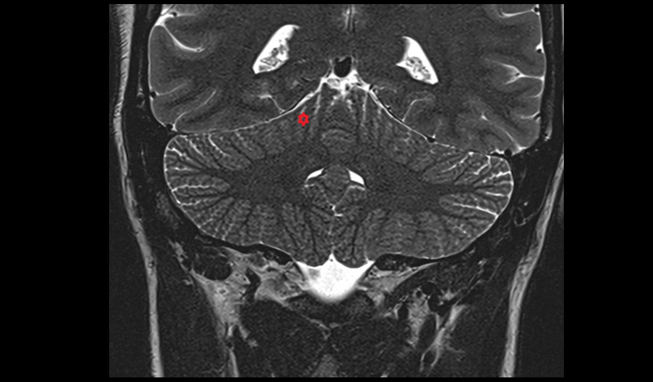 Anterior quadrangular lobule MRI 3T coronal image