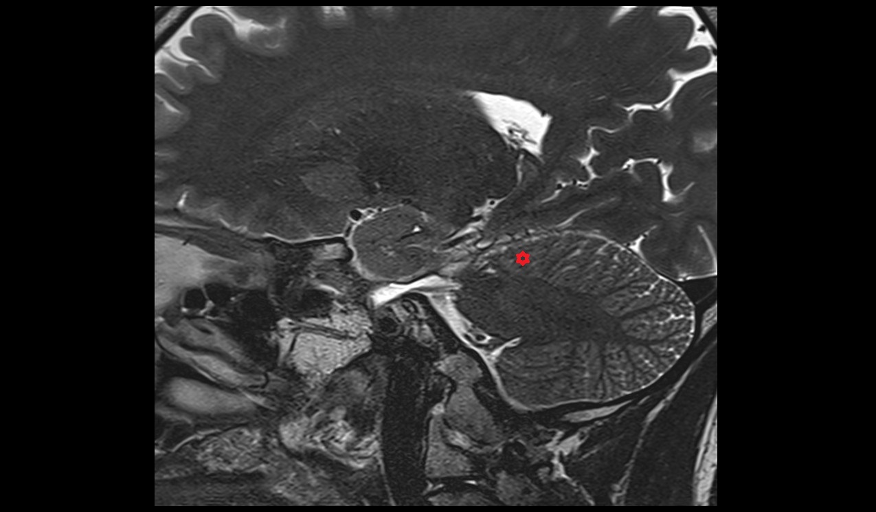 Anterior quadrangular lobule MRI 3T sagittal image