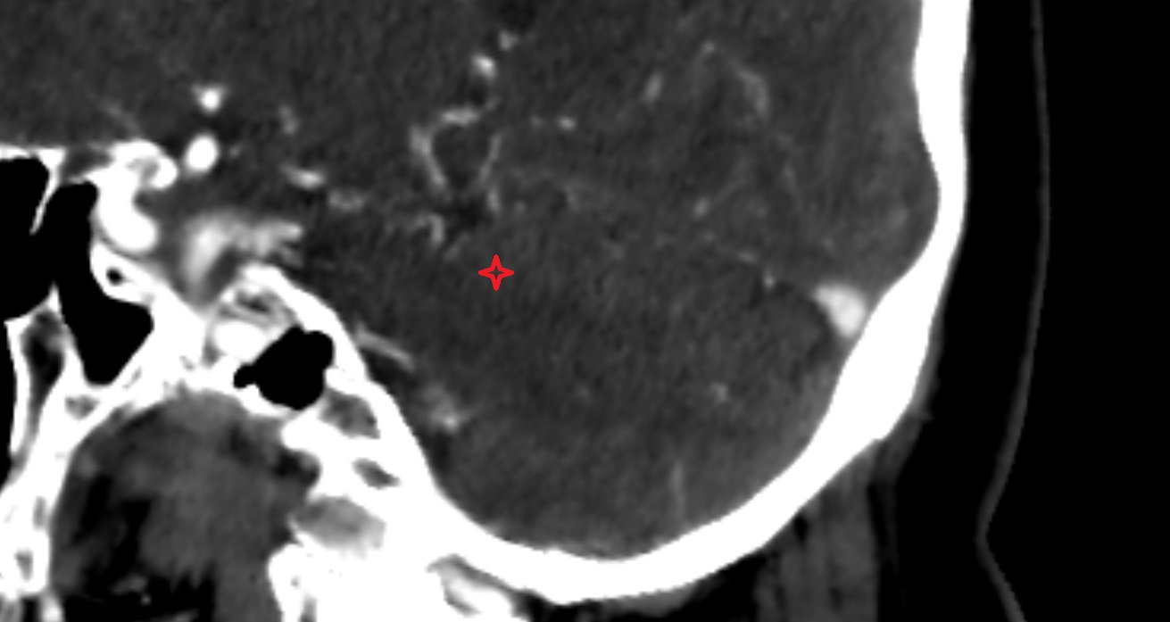 Anterior quadrangular lobule of cerebellum anatomy  CT sagittal  anatomy image -img-00001-00001