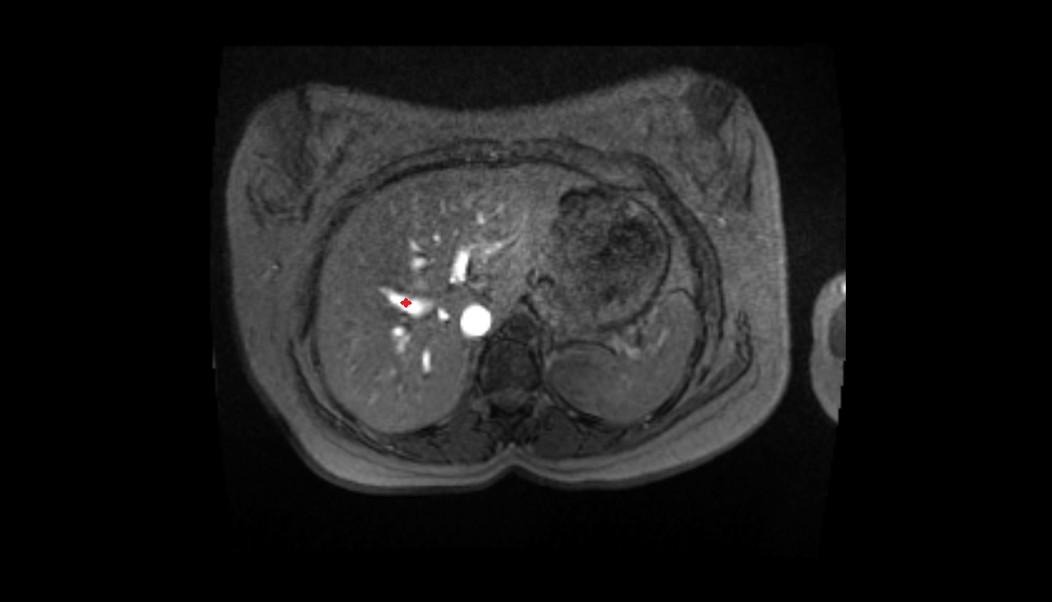 Anterior right portal branch MRI axial image