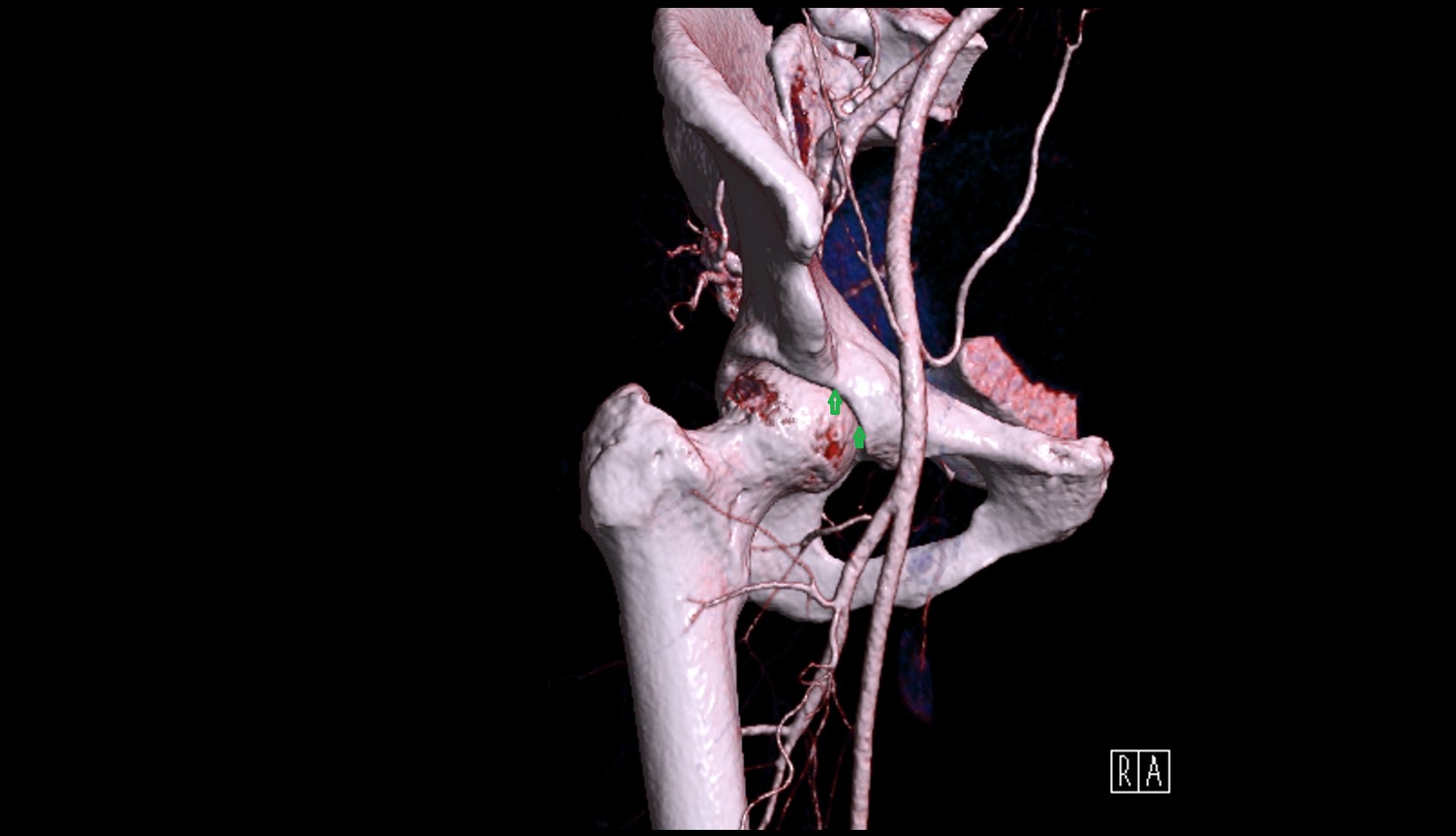 Anterior rim of acetabulum 3d