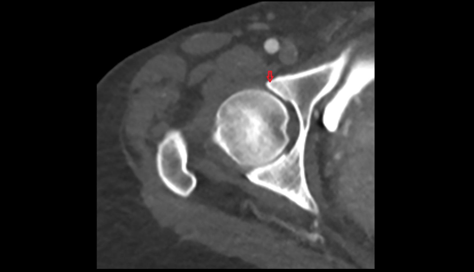 Anterior rim of acetabulum ct axial