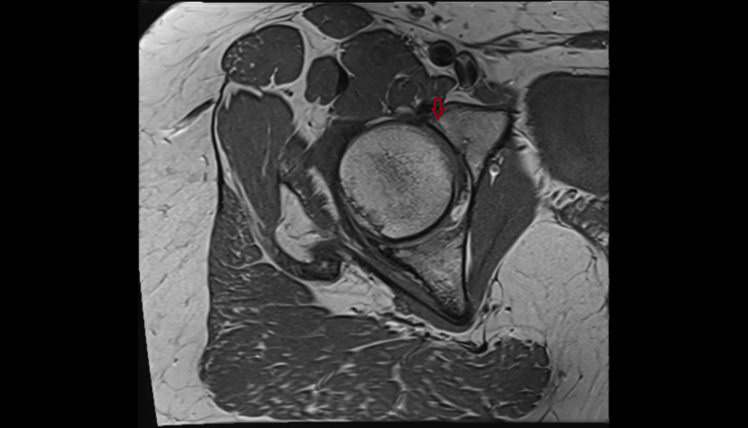 Anterior rim of acetabulum  mri  anatomy labelled image-img-00000-00000