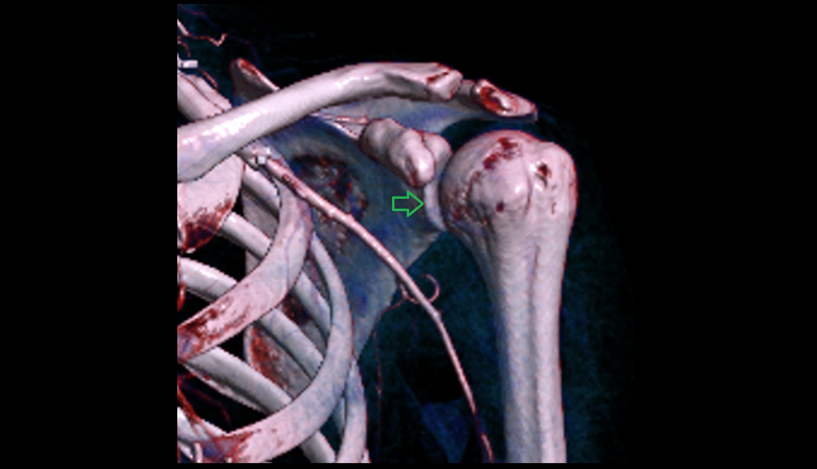 Anterior rim of glenoid