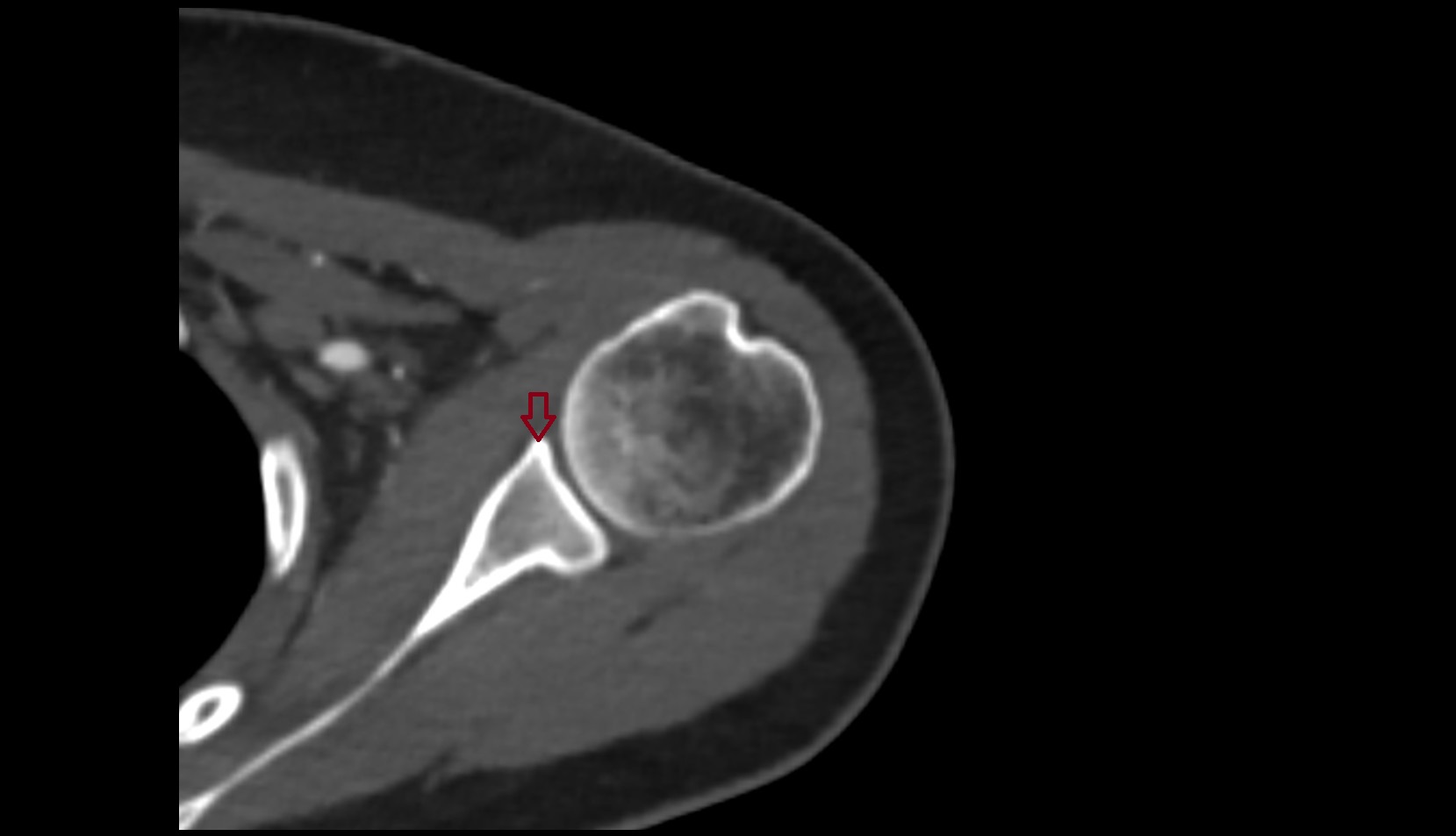 Anterior rim of glenoid ct